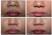 THE USE OF ALLOGENIC COLLAGEN GEL IN NASOLABIAL FOLD TREATMENT: AN EXPERIMENTAL ASSESSMENT