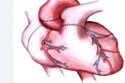 The outcomes of marginal donor hearts compared with ideal donors: a single-center experience in Iran